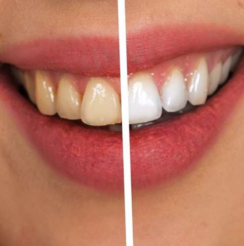 The Benefits of Getting Your Teeth Whitened by a Professional The Benefits of Getting Your Teeth Whitened by a Professional